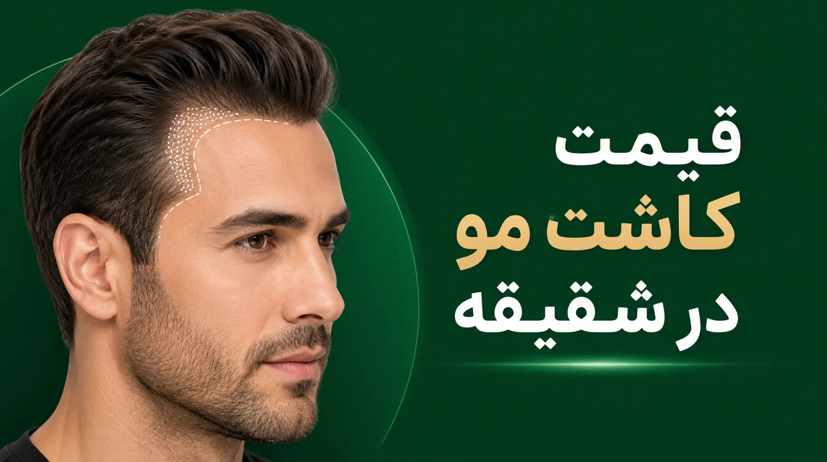 قیمت کاشت مو در شقیقه