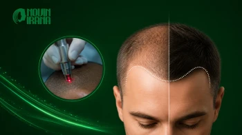عملية زراعة الشعر بالليزر