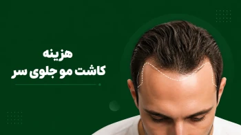 هزینه کاشت مو جلوی سر