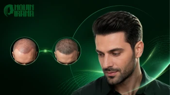 کاشت مو دو مرحله ای