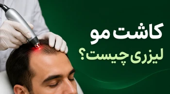 کاشت مو با لیزر