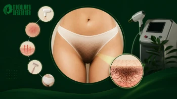 تیرگی بعد از لیزر بیکینی