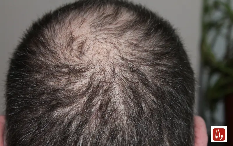 زراعة الحواجب ايران