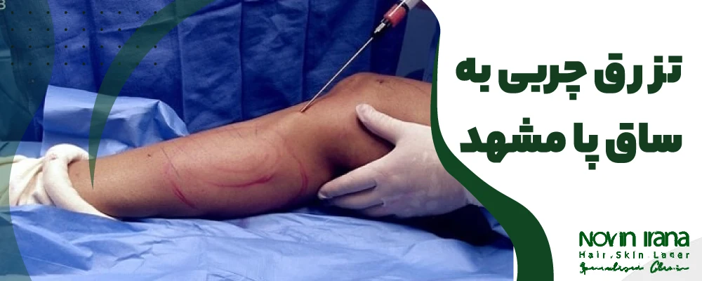 تزریق چربی ساق پا مشهد