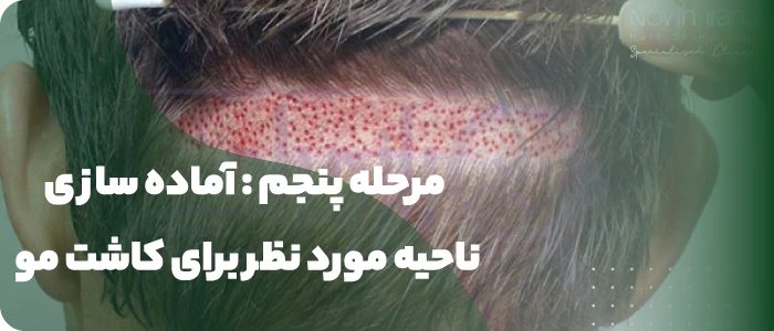 آماده سازی ناحیه مورد نظر برای کاشت مو