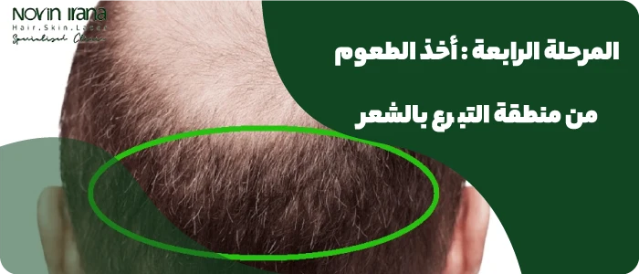 أخذ الطعوم من منطقة التبرع بالشعر