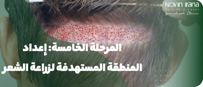 إعداد المنطقة المستهدفة لزراعة الشعر