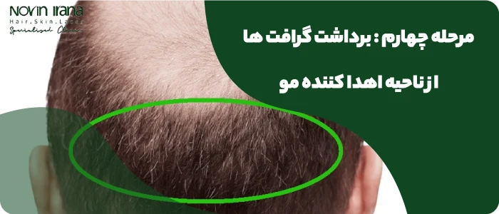 برداشت گرافت ها از ناحیه اهدا کننده مو