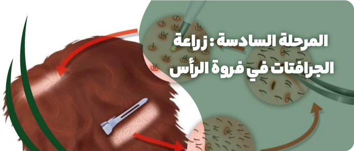 زراعة الجرافتات في فروة الرأس