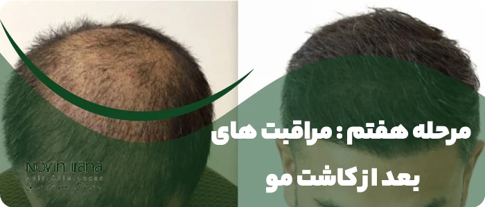 مراقبت های بعد از کاشت مو