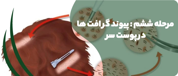 پیوند گرافت ها در پوست سر