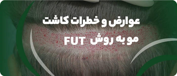 عوارض و خطرات کاشت مو به روش FUT