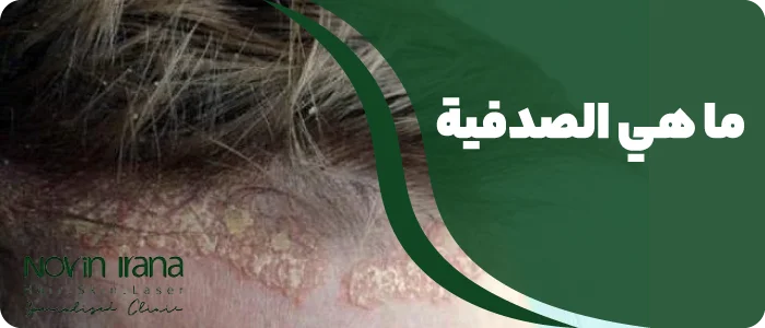 ما هي الصدفية