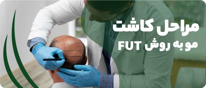 روش fut کاشت مو