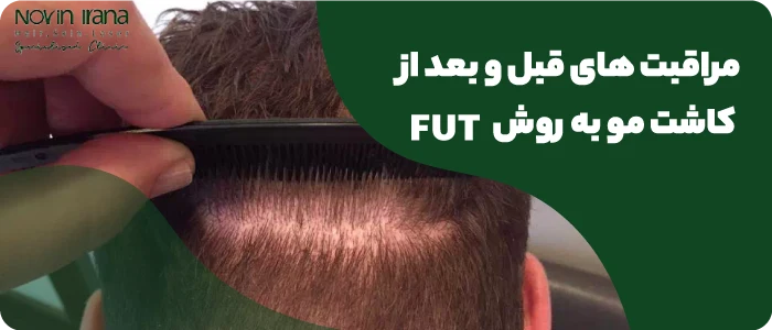 fut کاشت مو