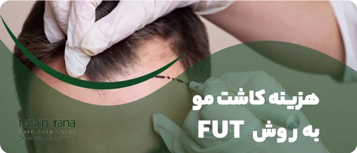 هزینه کاشت مو به روش FUT