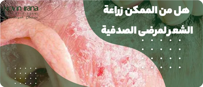 هل من الممكن زراعة الشعر لمرضى الصدفية