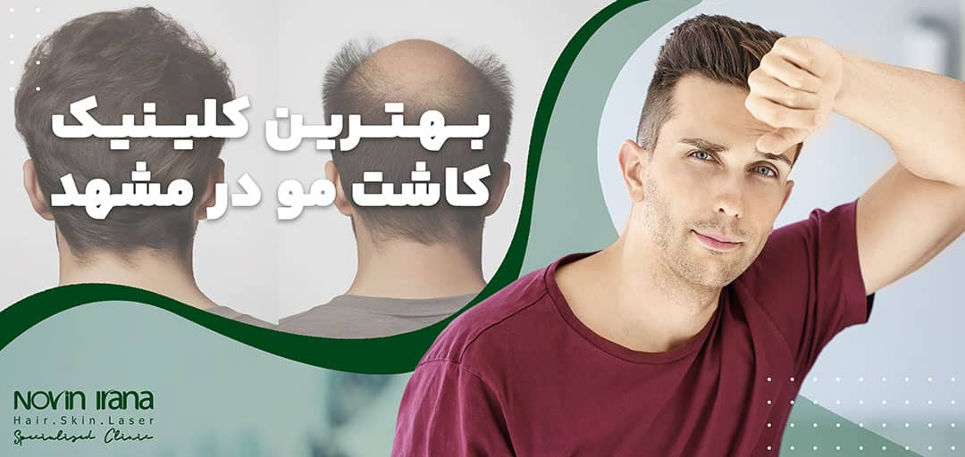 بهترین کلینیک کاشت مو در مشهد 