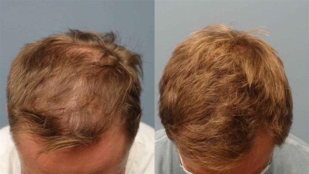 زراعة الشعر