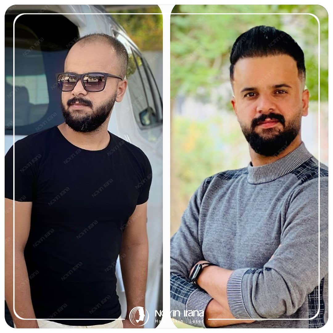 نمونه کاشت مو در مشهد
