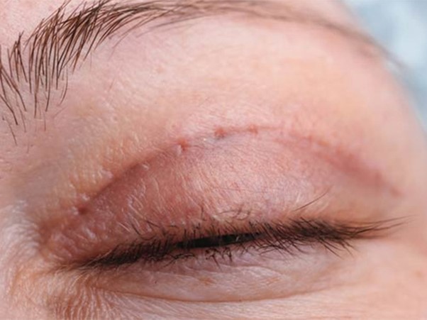 العوامل التي تسبب بقاء ندبات الخياطة بعد عملية تجميل الجفون