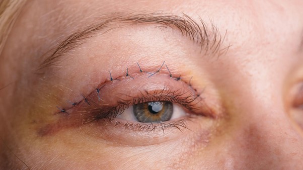 كيفية التخلص من ندبات خياطة عملية تجميل الجفون
