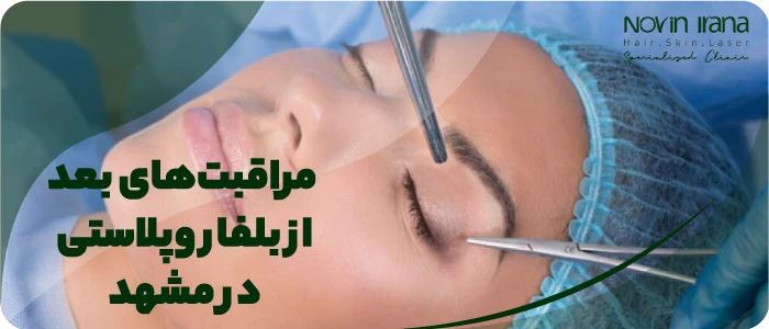 مراقبتهای بعد از بلفاروپلاستی در مشهد