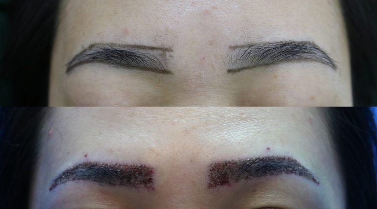 کاشت ابرو به روش fue