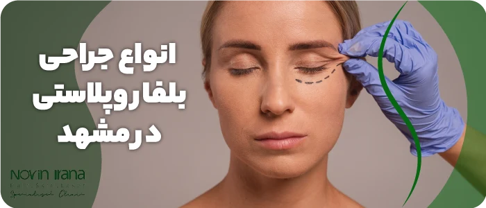 انواع جراحی بلفاروپلاستی در مشهد