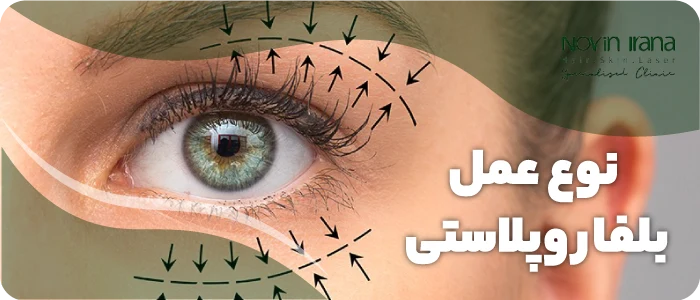 نوع عمل بلفاروپلاستی در شهر مشهد