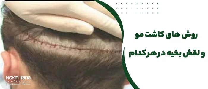  روش های کاشت مو و نقش بخیه در هر کدام