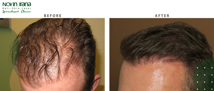 مضاعفات وفوائد زراعة الشعر الطبيعي