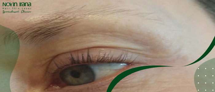 الأسباب المحتملة لتساقط شعر الحواجب تشمل عدة عوامل