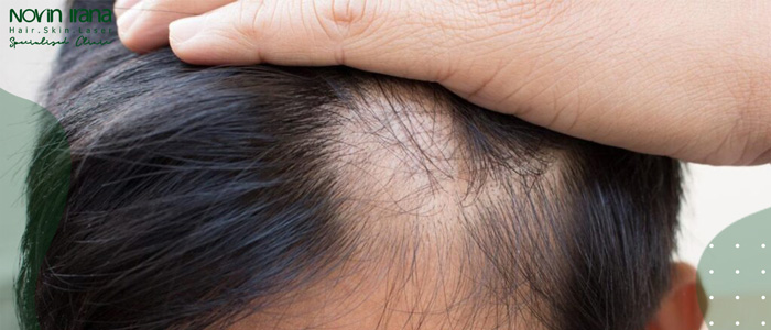 مضاعفات وفوائد زراعة الشعر الصناعي