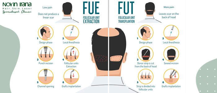زراعة الشعر في مشهد ايران