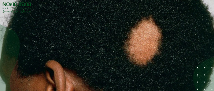 هل زراعة الشعر علاج لهذا المرض