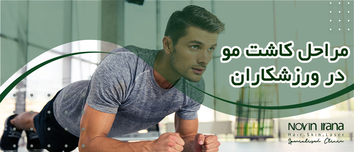مراحل کاشت مو در ورزشکاران