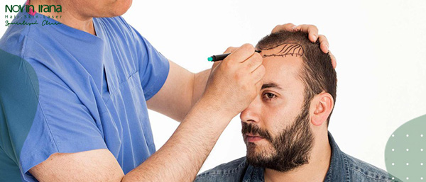 تكلفة زراعة الشعر في ايران