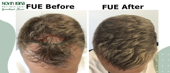 مدة نمو الشعر بعد زراعة الشعر في إيران