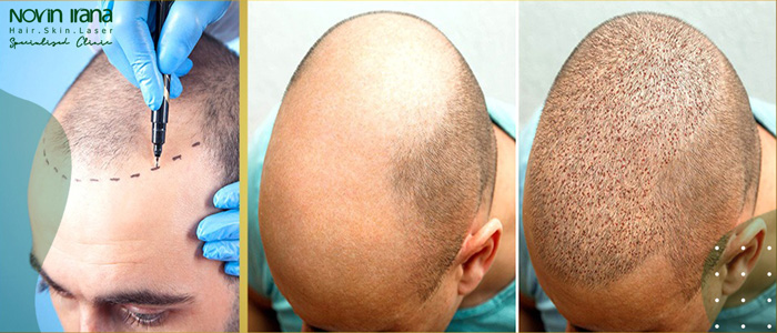 أفضل عيادة زراعة الشعر في مشهد