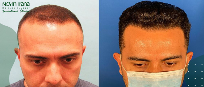 خطوات زراعة الشعر الصناعي