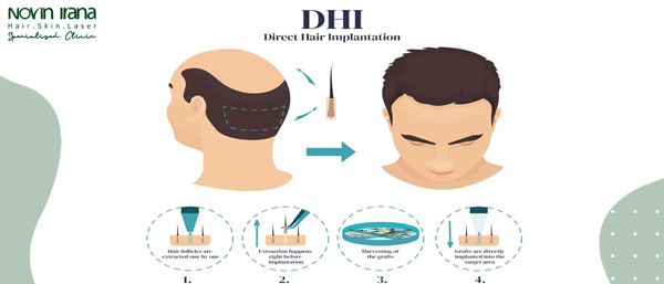 طريقة زراعة الشعر dhi