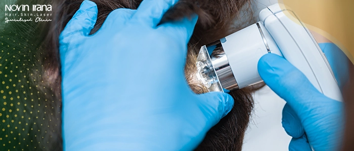 وش نوع التساقط الطبيعي بعد زراعة الشعر