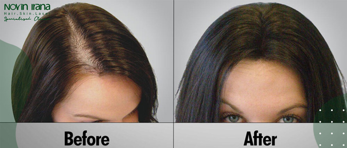 افضل عيادة زراعة الشعر للنساء في ايران