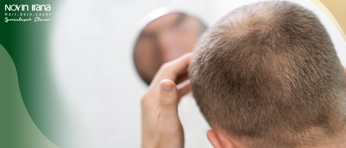 ما هي زراعة الشعر لمرضى السكر؟