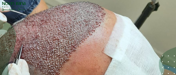 افضل دكتور لزراعة الشعر في ايران