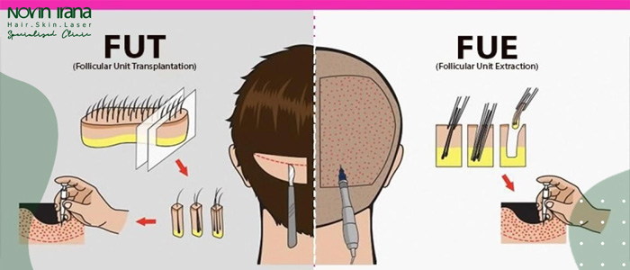 طريقة زراعة الشعر FUE