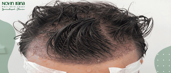 کاشت مو روی اسکار در کلینیک نوین ایرانا