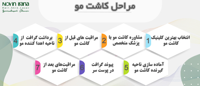 صفر تا صد مراحل کاشت مو