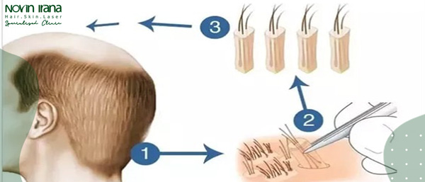 طريقة زراعة الشعر PRP